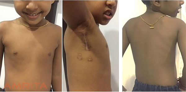 L’Ospedale Amrita dà il via ai primi interventi di cardiochirurgia estetica infantile in India